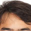 分け目ハゲ